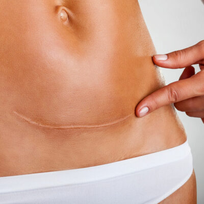 A Comprehensive Guide on Signs and Diagnosis of Ovarian Cancer