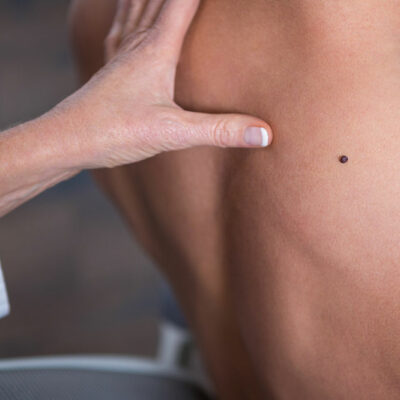 Learn About the Common and Rare Types of Melanoma