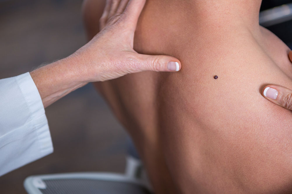 Learn About the Common and Rare Types of Melanoma