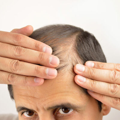 7 Lifestyle Changes That Can Reduce Hair Loss
