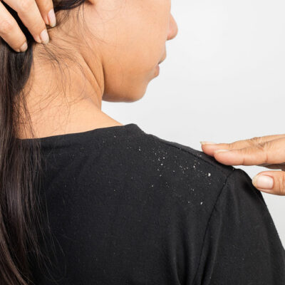7 Lifestyle Changes to Help Banish Dandruff