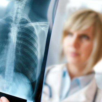 5 Warning Signs of Lung Cancer: